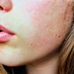 seborrheic dermatitis on cheek