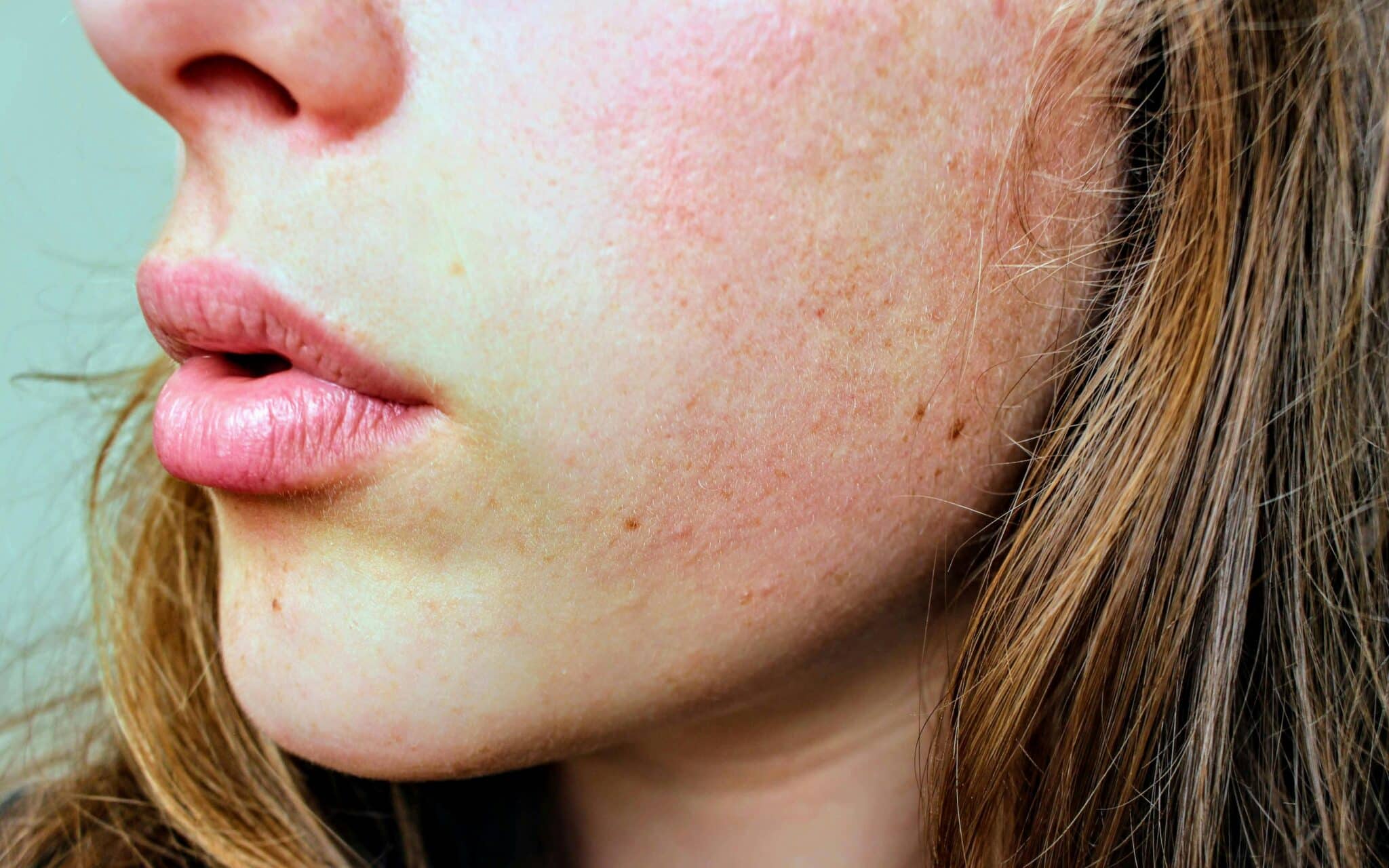 seborrheic dermatitis on cheek
