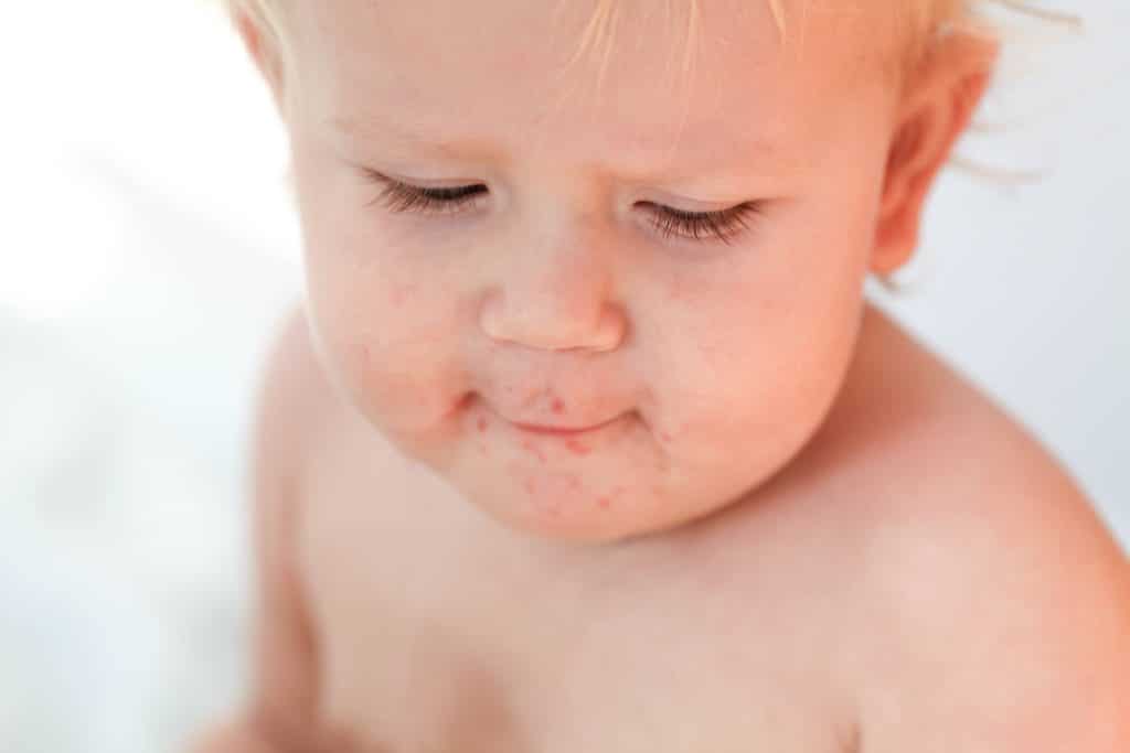 Infant perioral dermatitis,
