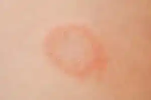 ringworm rash,