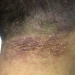 Shampoo Soothes Seborrheic Dermatitis