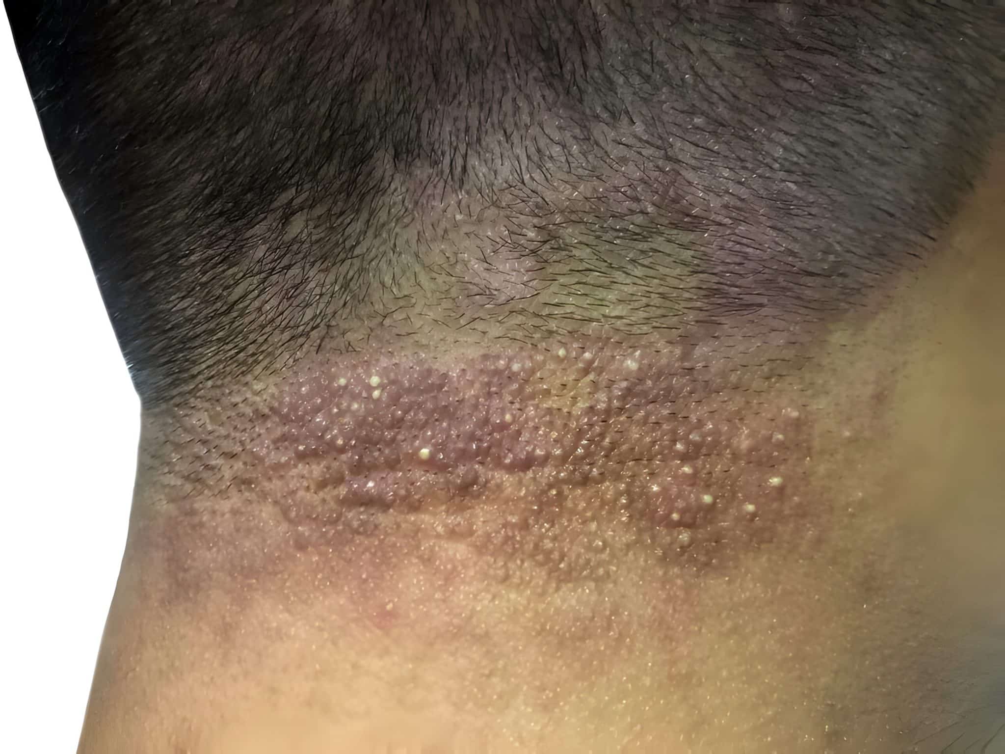 Shampoo Soothes Seborrheic Dermatitis