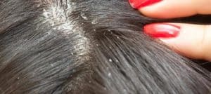 seborrheic dermatitis shampoo, best shampoo for seborrheic dermatitis, seborrheic dermatitis treatments, antifungal shampoo for scalp, natural remedies for seborrheic dermatitis, The Best Shampoos for Seborrheic Dermatitis and Psoriasis, best shampoo for Seborrheic dermatitis, which shampoo is best for seborrheic dermatitis, this shampoo for seborrheic dermatitis,