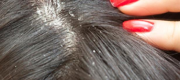 best shampoo for Seborrheic dermatitis, which shampoo is best for seborrheic dermatitis, this shampoo for seborrheic dermatitis,