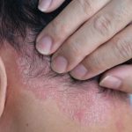 Best Shampoo for Seborrheic Dermatitis Uk, Best Shampoo for Seborrheic Dermatitis Uk, shampoo for seborrheic dermatitis