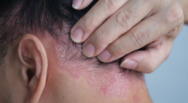 Best Shampoo for Seborrheic Dermatitis Uk, Best Shampoo for Seborrheic Dermatitis Uk, shampoo for seborrheic dermatitis