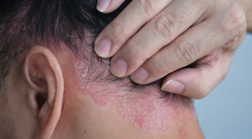 Best Shampoo for Seborrheic Dermatitis Uk, Best Shampoo for Seborrheic Dermatitis Uk, shampoo for seborrheic dermatitis