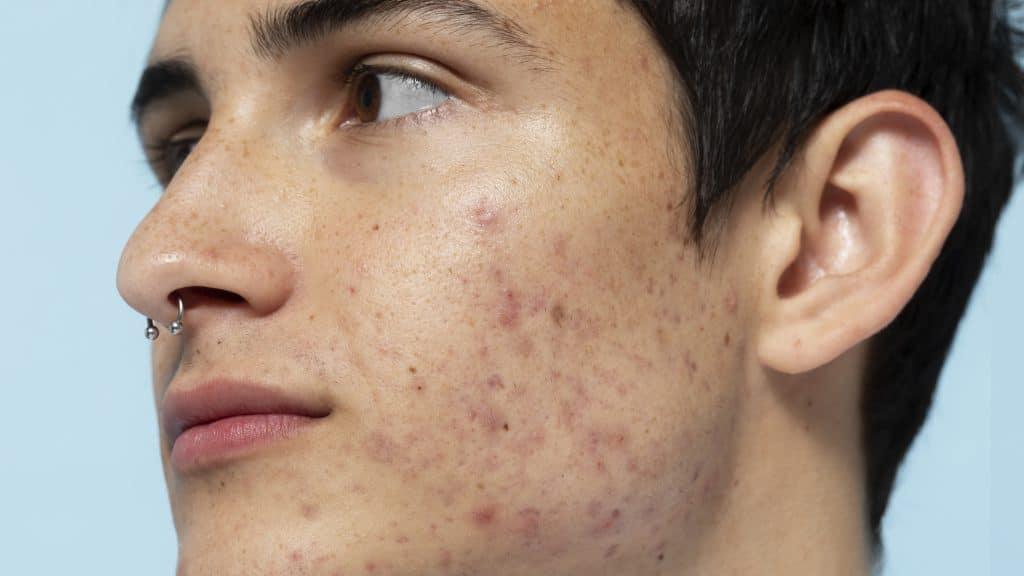 scars, facial scars,