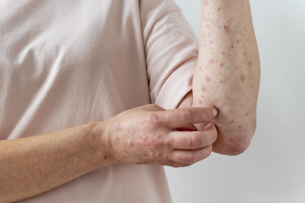 skin rash,