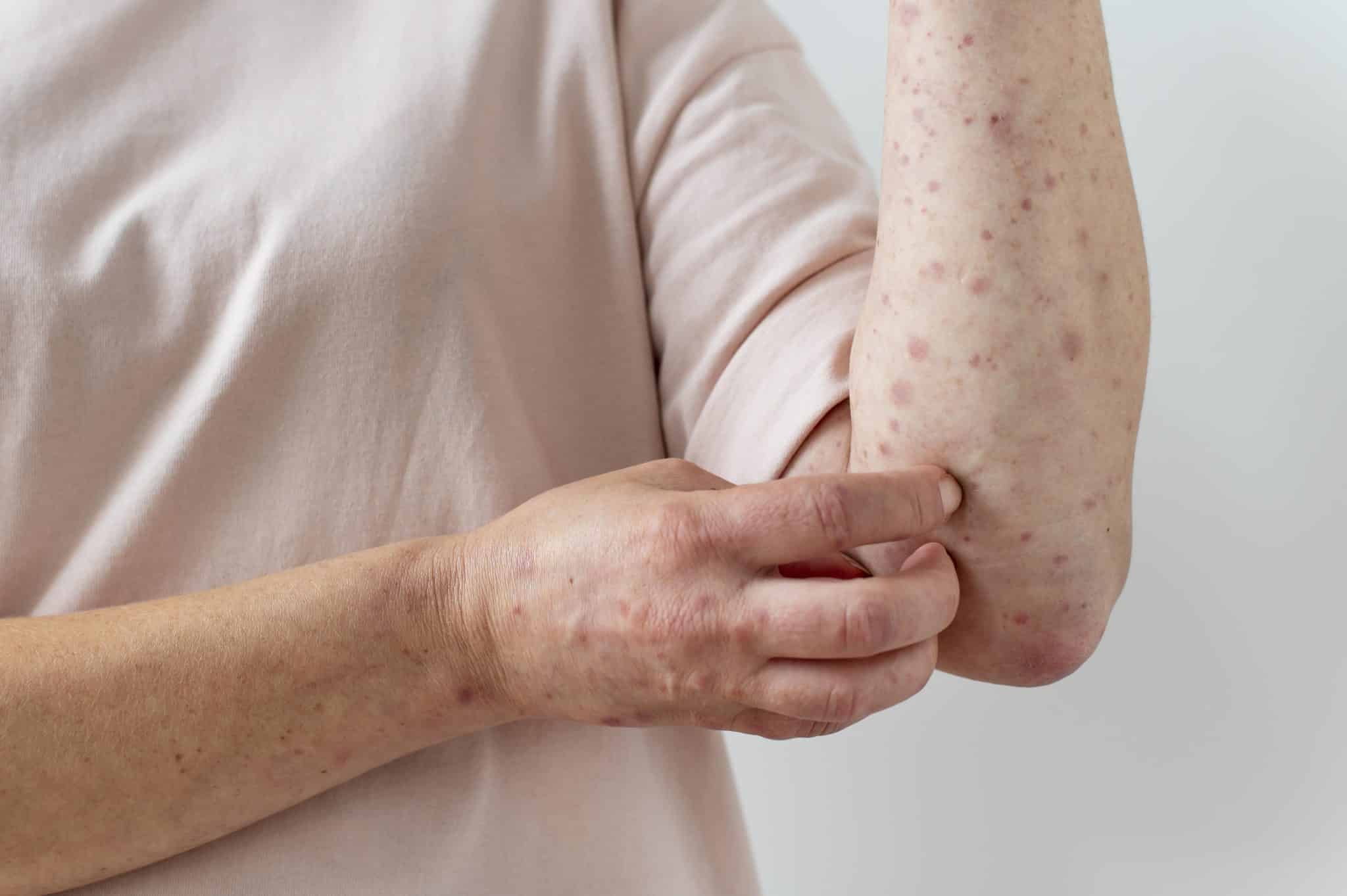 skin rash,