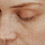 FACE DAMAGED BY THE SUN,