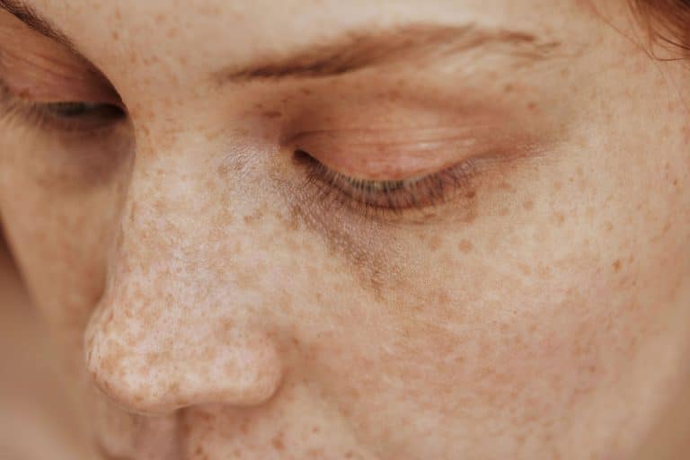 FACE DAMAGED BY THE SUN,