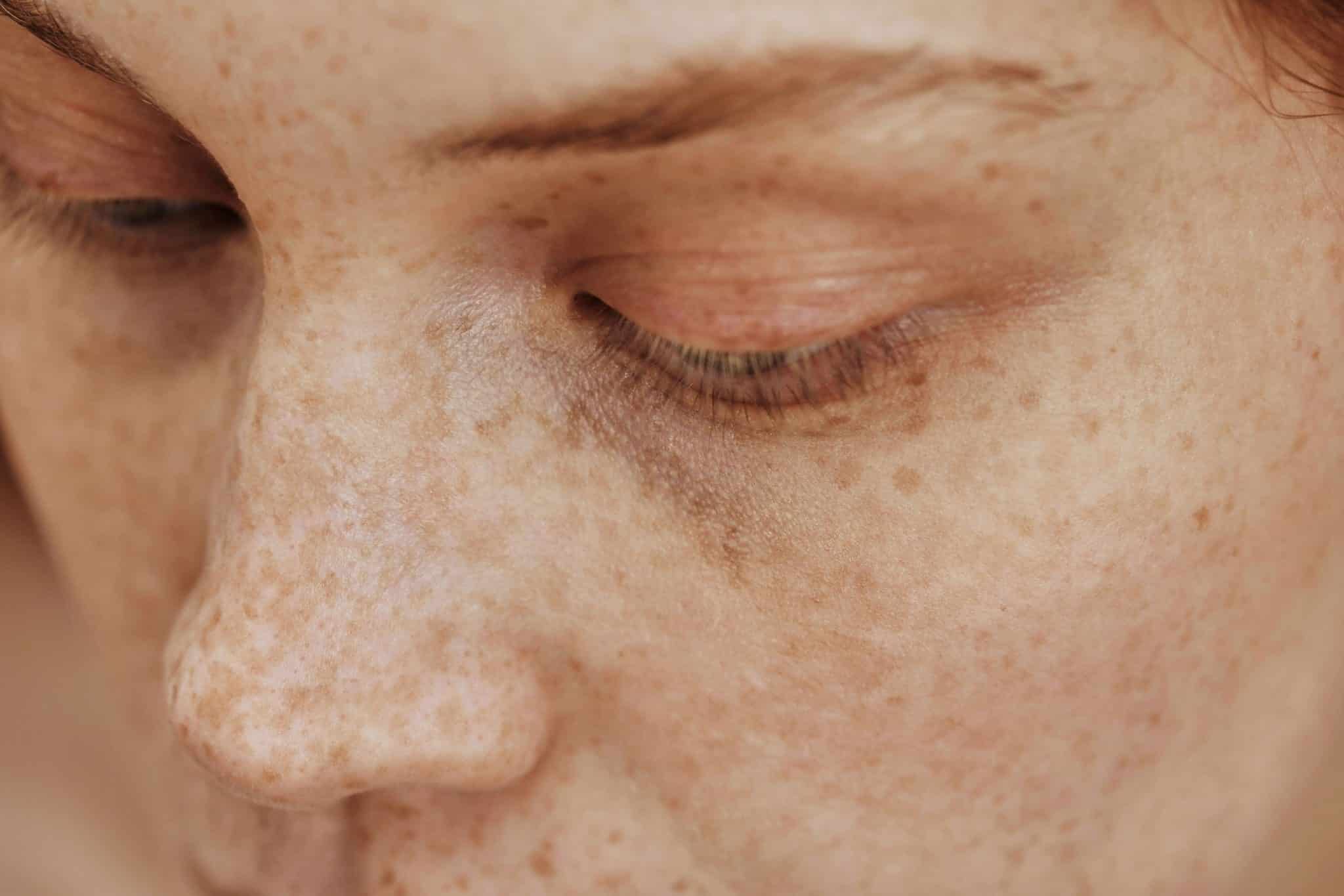 FACE DAMAGED BY THE SUN,