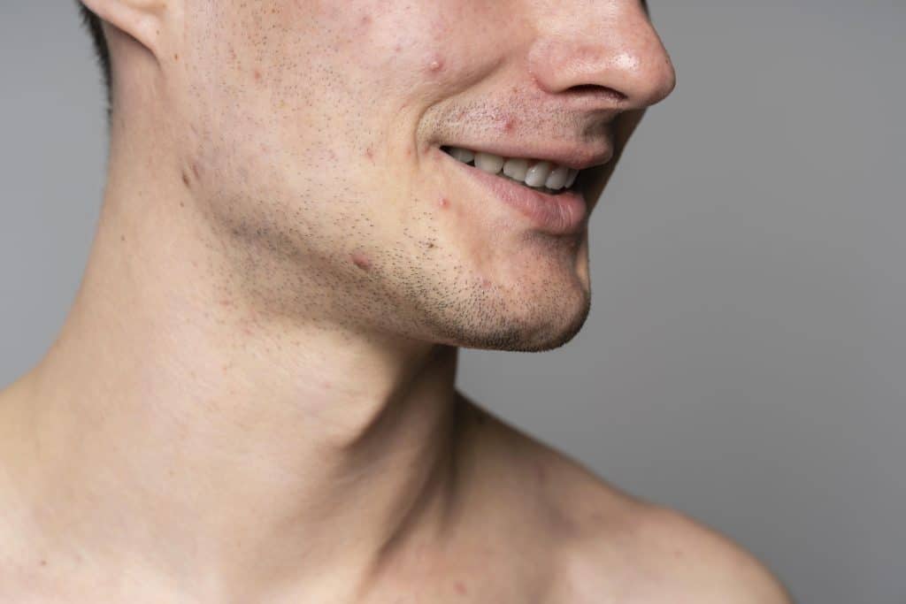 scars, facial scarring,
