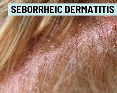 seborrheic dermatitis on the scalp