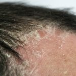 best shampoo for psoriasis, Best Anti-Dandruff Shampoos for Psoriasis and Seborrheic Dermatitis, The Ultimate Guide to Sebaceous Dermatitis Shampoo for a Healthy Scalp, Seborrhoeic Eczema Shampoo,