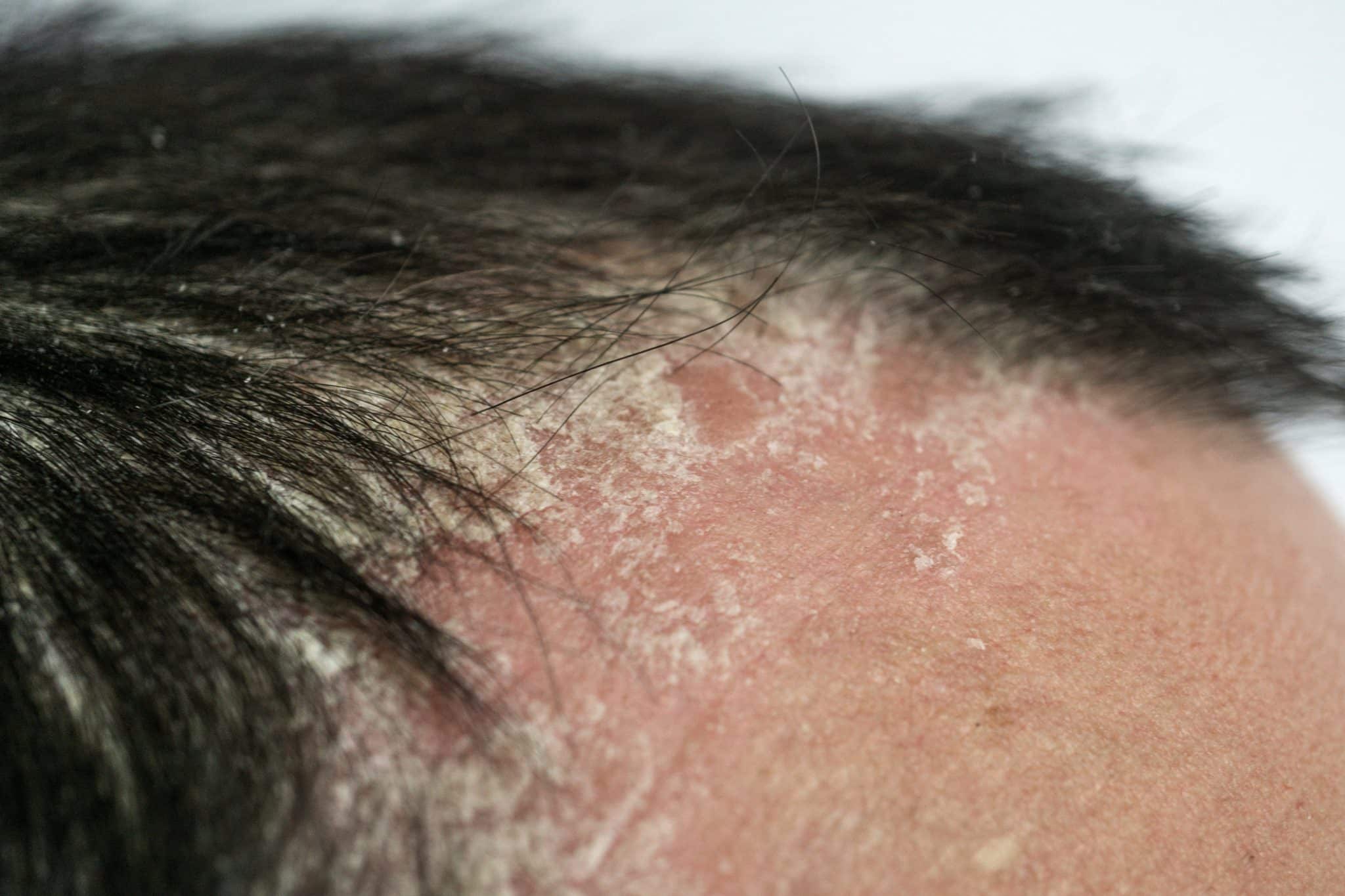 best shampoo for psoriasis, Best Anti-Dandruff Shampoos for Psoriasis and Seborrheic Dermatitis, The Ultimate Guide to Sebaceous Dermatitis Shampoo for a Healthy Scalp, Seborrhoeic Eczema Shampoo,