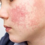 childhood eczema