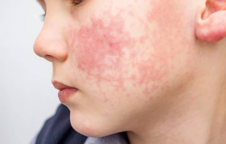 childhood eczema