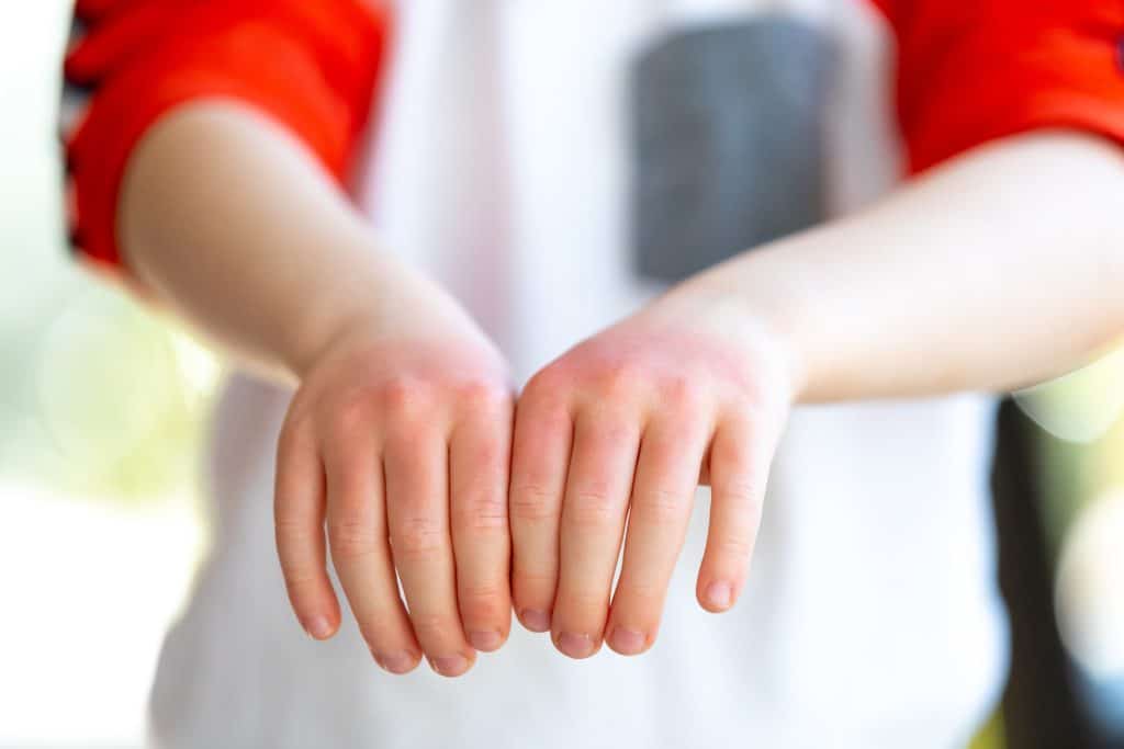 childhood eczema