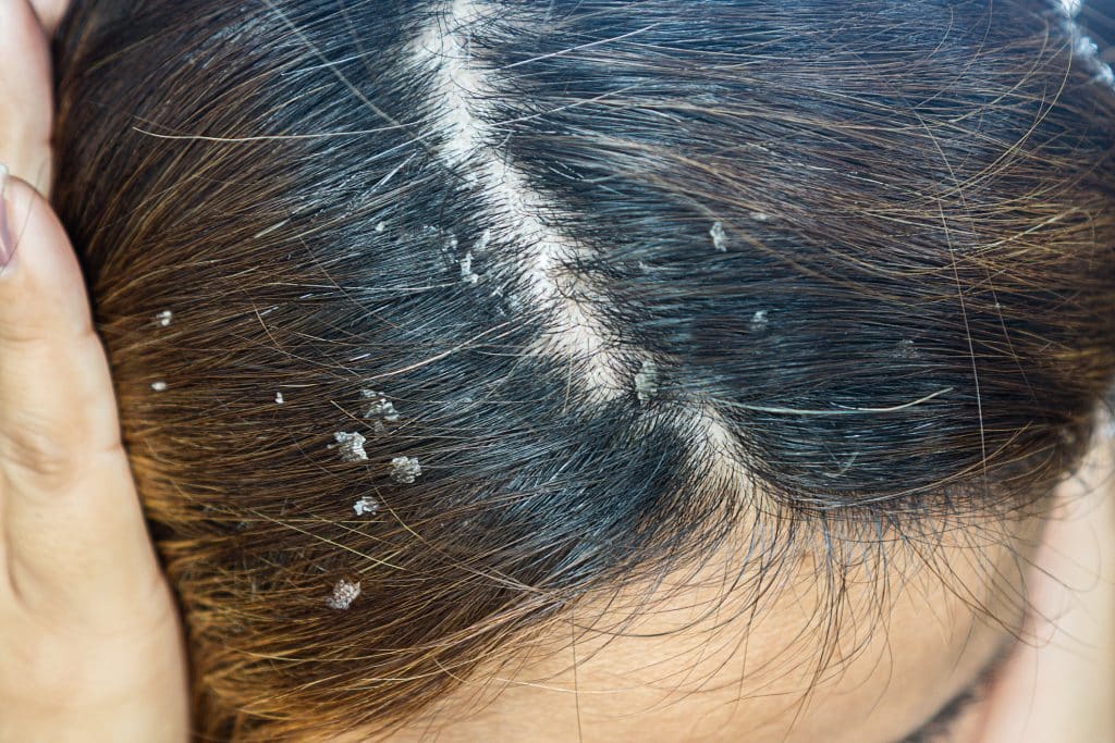 The Best Shampoos for Seborrheic Dermatitis and Psoriasis