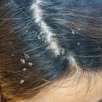 scalp psoriasis shampoo,