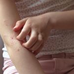 eczema prone skin,