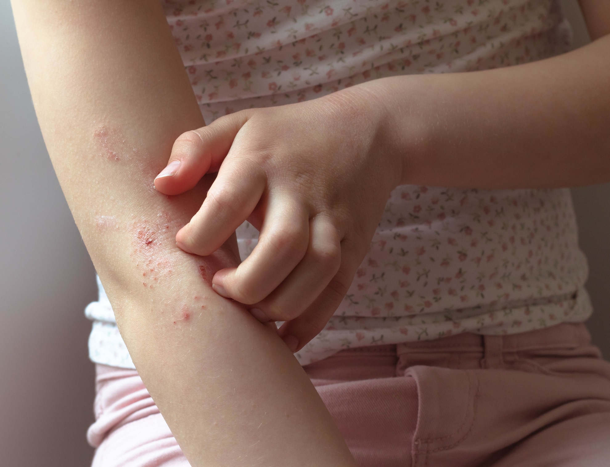 eczema prone skin,