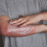Natural Psoriasis Creams