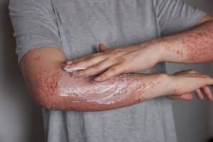 Natural Psoriasis Creams