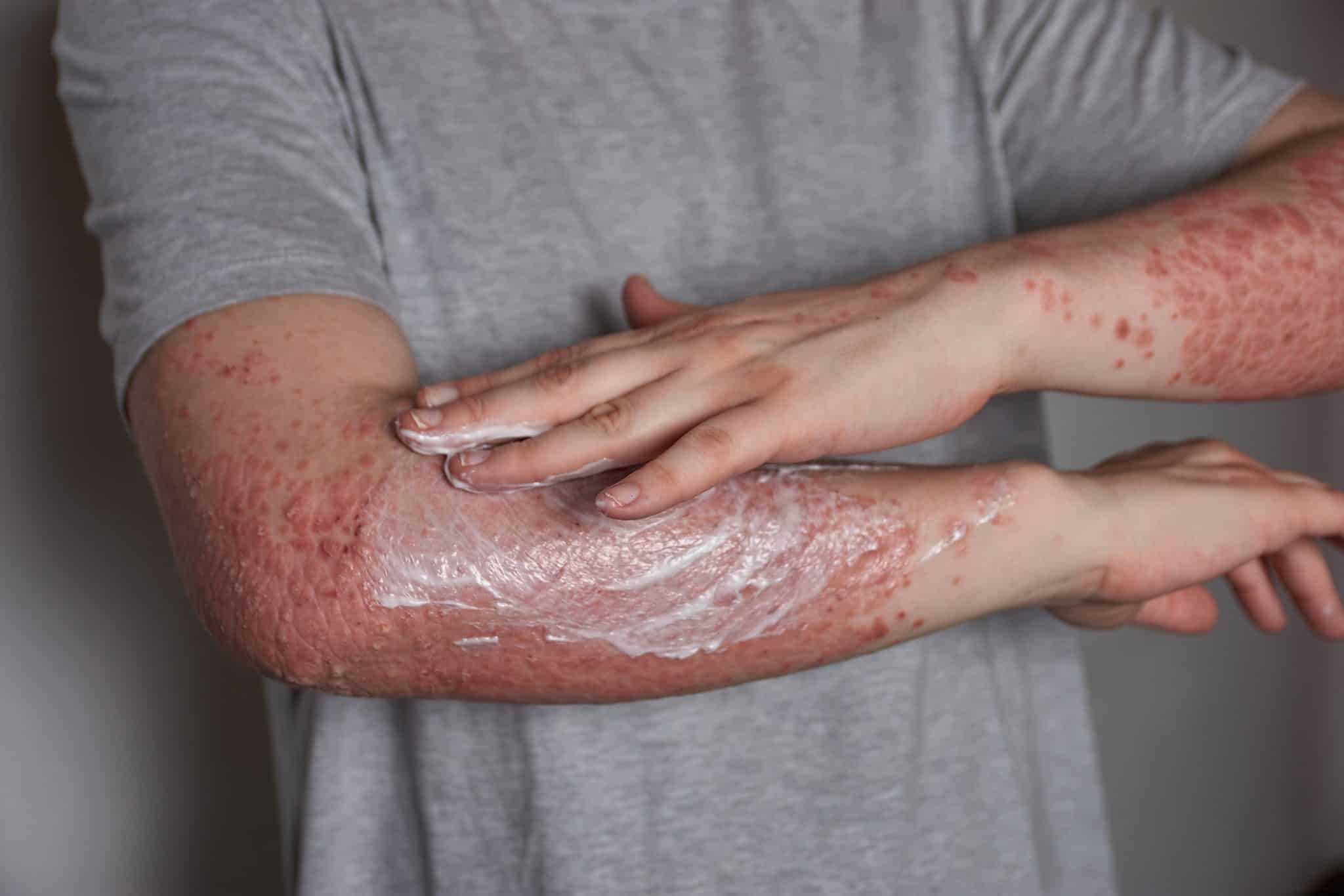 Natural Psoriasis Creams