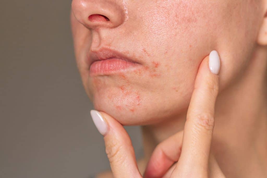 eczema around the mouth, treat eczema, ​perioral dermatitis, facial rash, skin irritation, acne-like rash, facial bumps, Best Skincare for Perioral Dermatitis