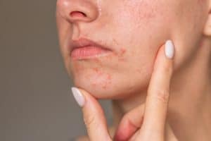 perioral dermatitis, facial rash treatment, skin irritation around mouth, rosacea vs perioral dermatitis, perioral dermatitis causes, eczema around the mouth, treat eczema, ​perioral dermatitis, facial rash, skin irritation, acne-like rash, facial bumps, Best Skincare for Perioral Dermatitis