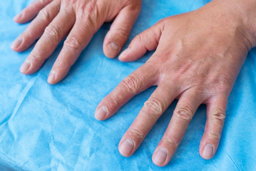 ​psoriasis cream, best psoriasis cream Ireland, natural psoriasis treatments, psoriasis cream reviews, topical treatments for psoriasis, How to Choose the Best Psoriasis Cream for Your Skin, Medication to Treat Psoriatic Arthritis, Psoriatic Arthritis,