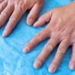 Eczema Creams for Dry and Cracked Skin, How to Choose the Best Psoriasis Cream for Your Skin, Medication to Treat Psoriatic Arthritis, Psoriatic Arthritis,