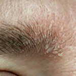 seborrheic dermatitis on the eyebrow