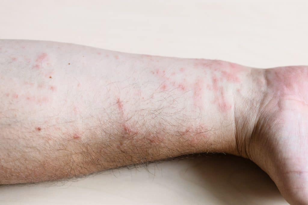 drematitis cream, eczema cream, skin rash treatment, anti-itch cream, dermatitis relief cream, Best Cream for Contact Dermatitis