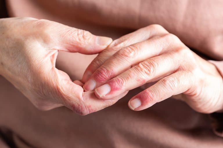 Hands with eczema applying fragrance-free moisturiser