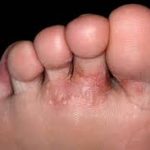 Dyshidrotic Eczema: Feet and Hands