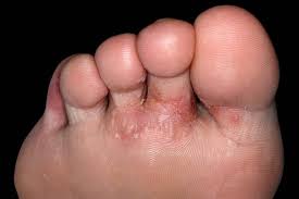 Dyshidrotic Eczema: Feet and Hands
