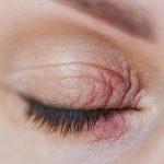 eyelid eczema, eyelid dermatitis, eye eczema treatment, itchy eyelids, eyelid rash causes, what is eyelid eczema, Eyelid Eczema Treatment at HomeTreat Eczema on Eyelids, eyelid eczema,