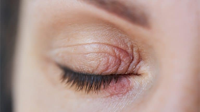 ​eyelid eczema, eyelid dermatitis, eye eczema treatment, itchy eyelids, eyelid rash causes, what is eyelid eczema, Eyelid Eczema Treatment at HomeTreat Eczema on Eyelids, eyelid eczema,