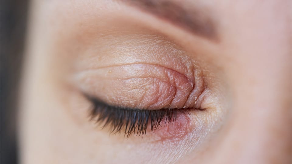 ​eyelid eczema, eyelid dermatitis, eye eczema treatment, itchy eyelids, eyelid rash causes, what is eyelid eczema, Eyelid Eczema Treatment at HomeTreat Eczema on Eyelids, eyelid eczema,