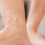 Dyshidrotic Eczema Treatment Feet