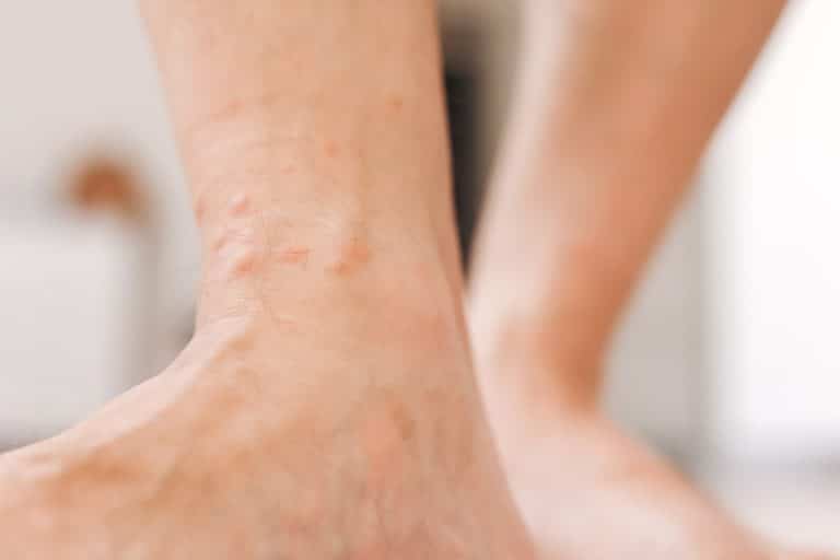Dyshidrotic Eczema Treatment Feet