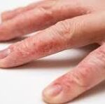 dermatitis on fingers