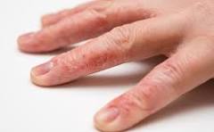 dermatitis on fingers with red, dry, cracked skin