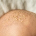 Seborrheic Dermatitis on the Scalp, dermatitis, eczema, skin rash, itchy skin, allergic reaction,