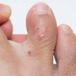 Dyshidrotic Eczema Treatment Cream, Dyshidrotic Eczema on Feet, dyshidrotic eczema feet