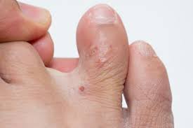 Dyshidrotic Eczema Treatment Cream, Dyshidrotic Eczema on Feet, dyshidrotic eczema feet
